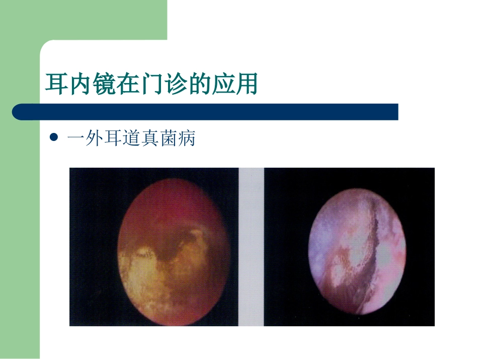 耳内镜的临床应用。谢和新_第10页