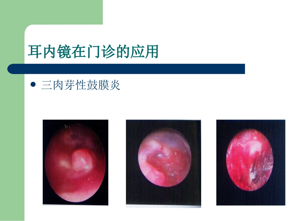耳内镜的临床应用。谢和新_第12页