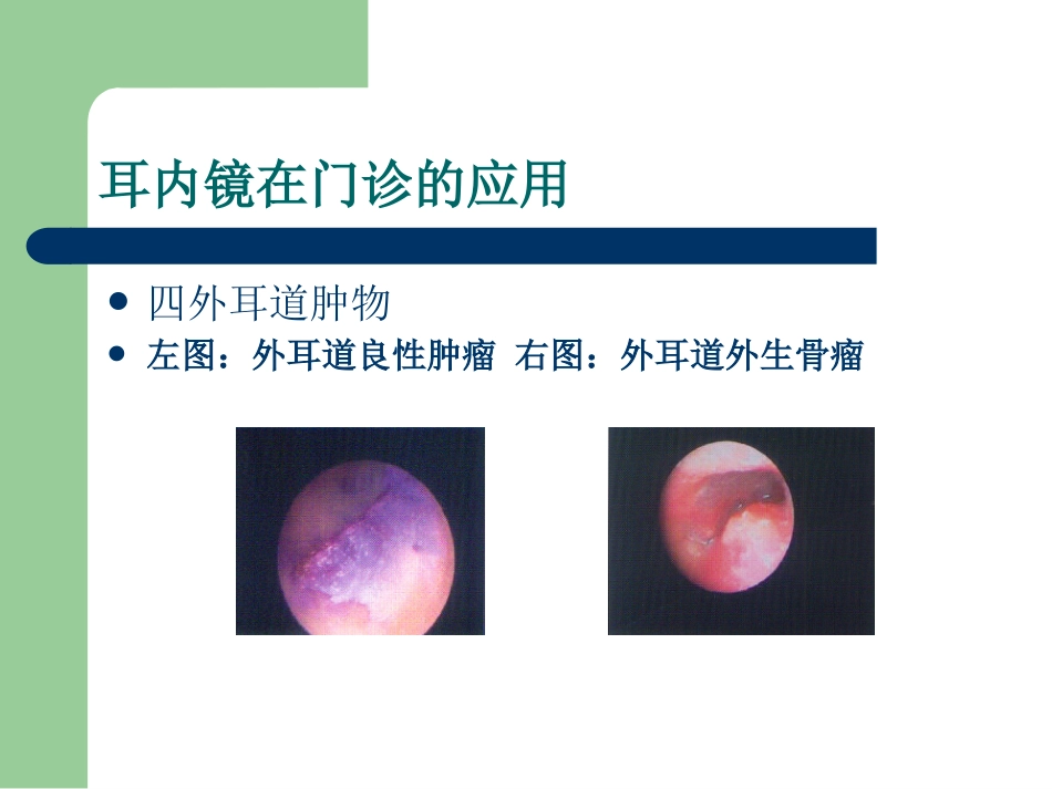 耳内镜的临床应用。谢和新_第13页