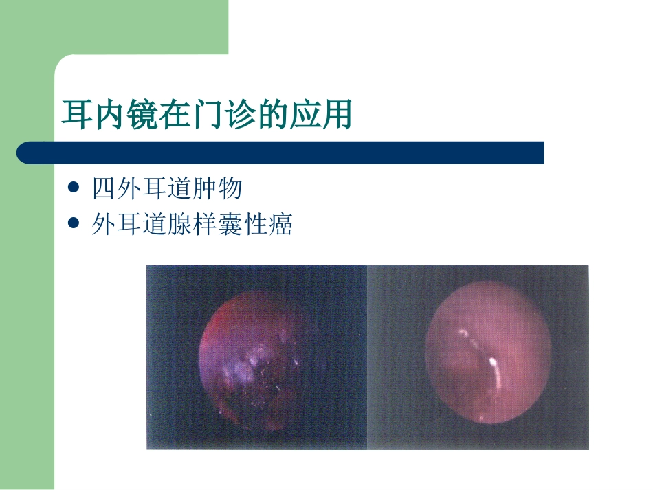 耳内镜的临床应用。谢和新_第14页