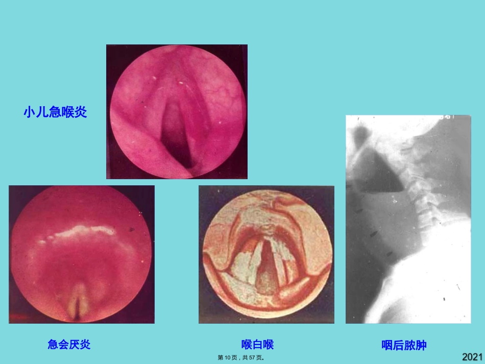 耳鼻咽喉头颈外科学喉阻塞_第10页