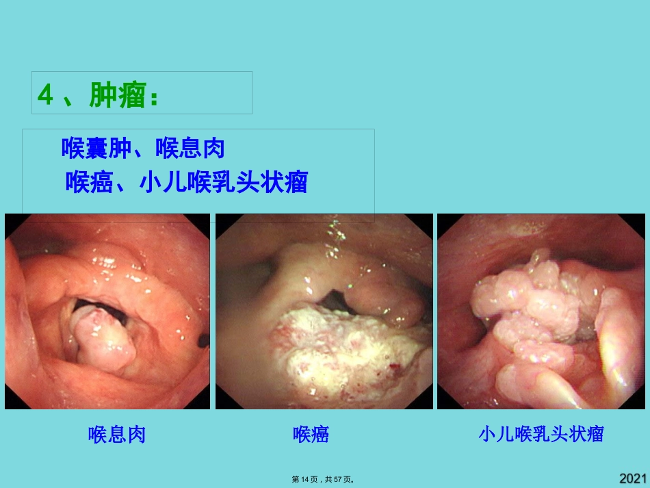 耳鼻咽喉头颈外科学喉阻塞_第14页