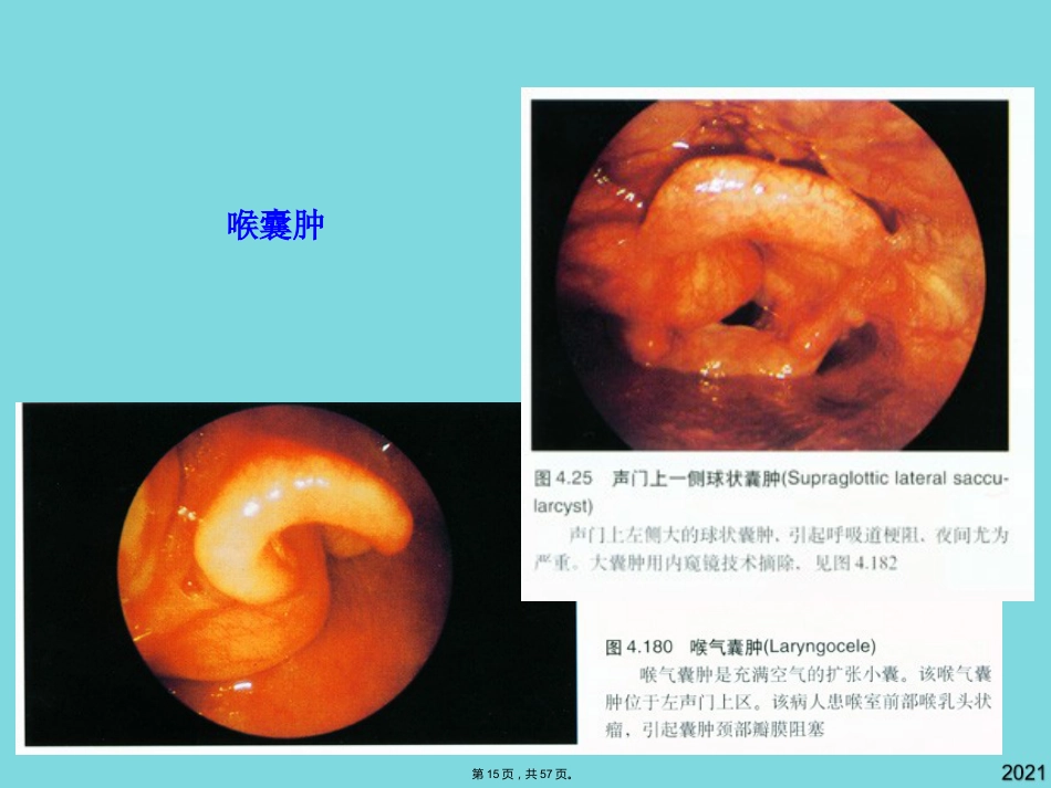 耳鼻咽喉头颈外科学喉阻塞_第15页