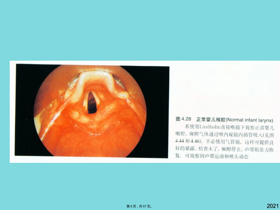 耳鼻咽喉头颈外科学喉阻塞_第6页