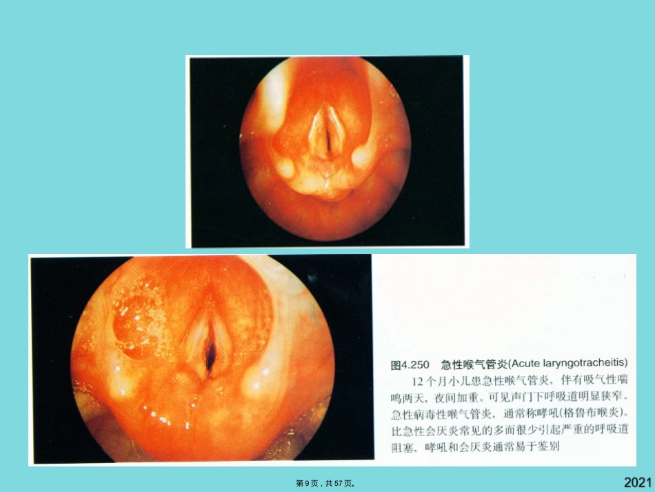 耳鼻咽喉头颈外科学喉阻塞_第9页