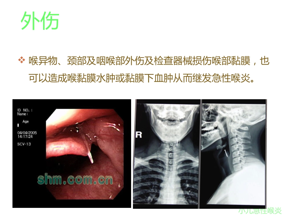 急性喉炎PPT课件_第8页