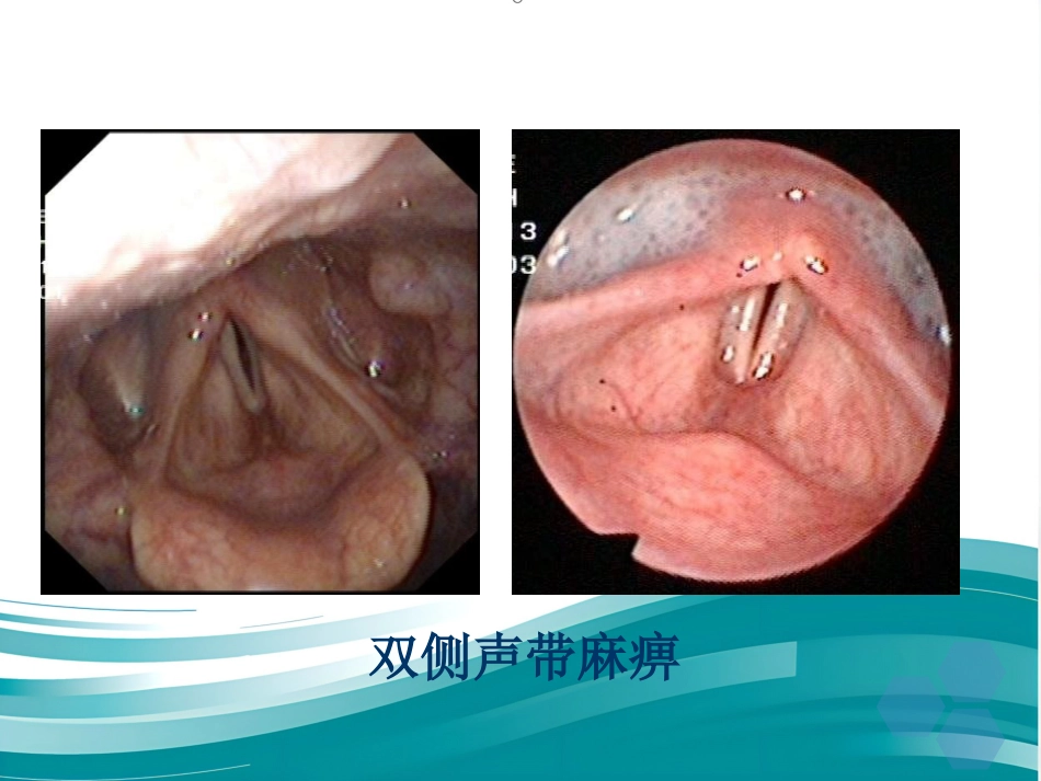 喉的神经性疾病_第14页