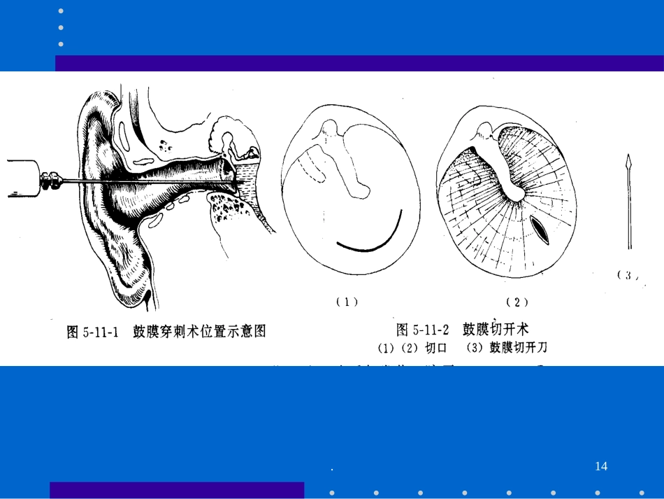 分泌性中耳炎_第14页