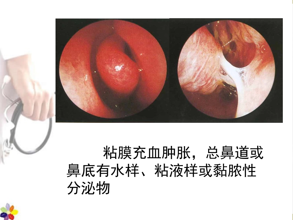 鼻窦炎课件_第6页