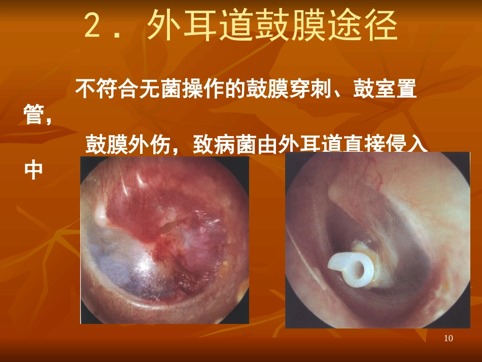 急性化脓性中耳炎ppt课件_第10页
