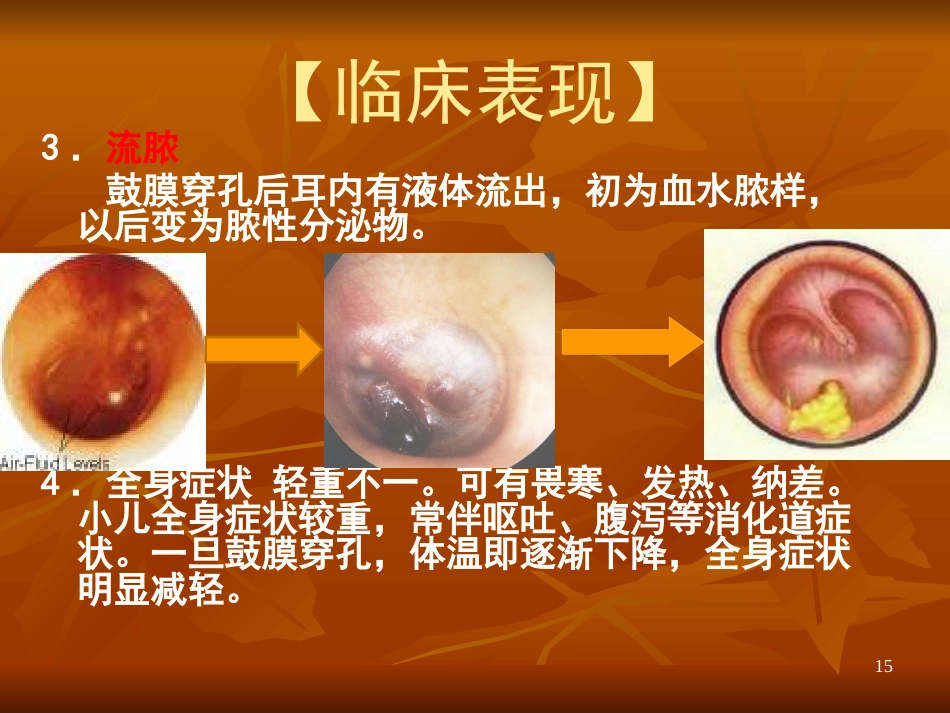 急性化脓性中耳炎ppt课件_第15页