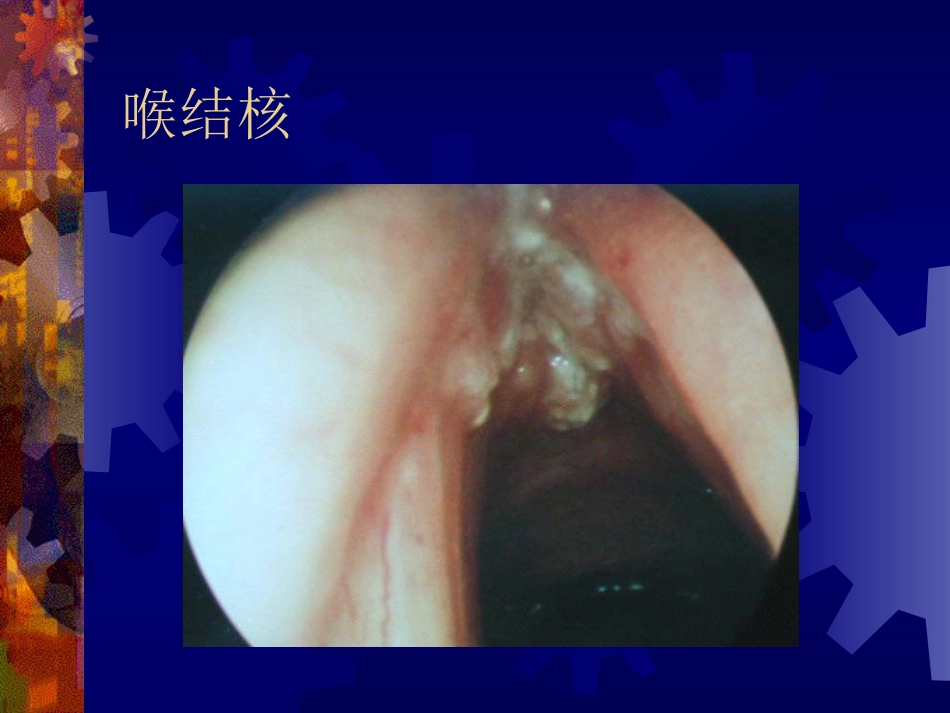 喉阻塞_第11页