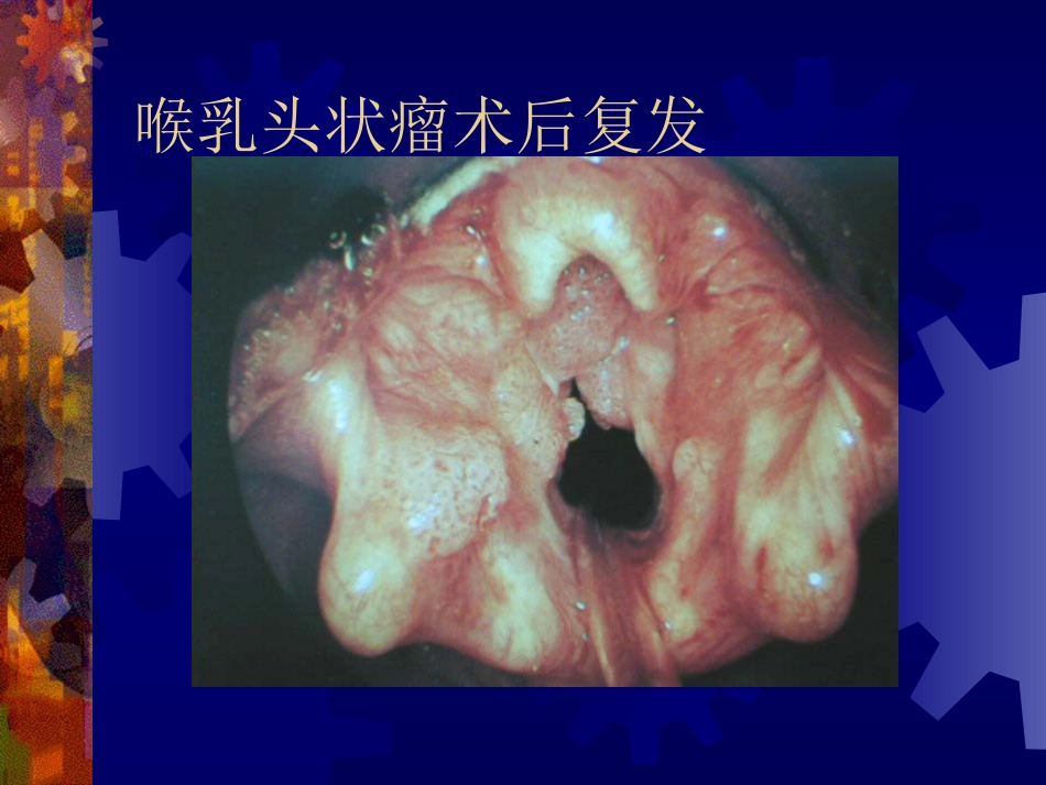 喉阻塞_第13页