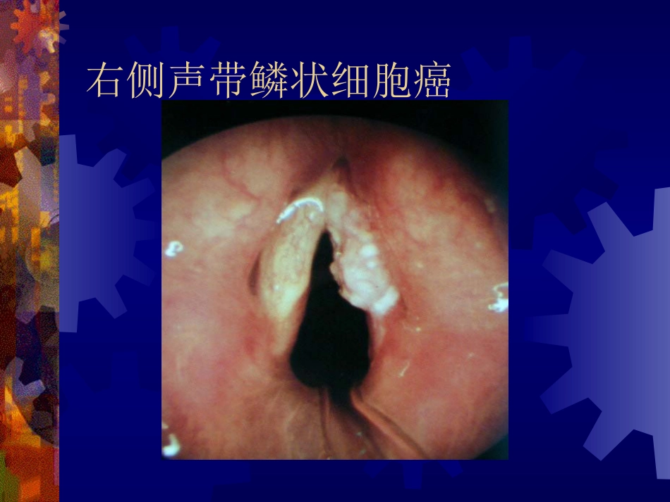 喉阻塞_第14页