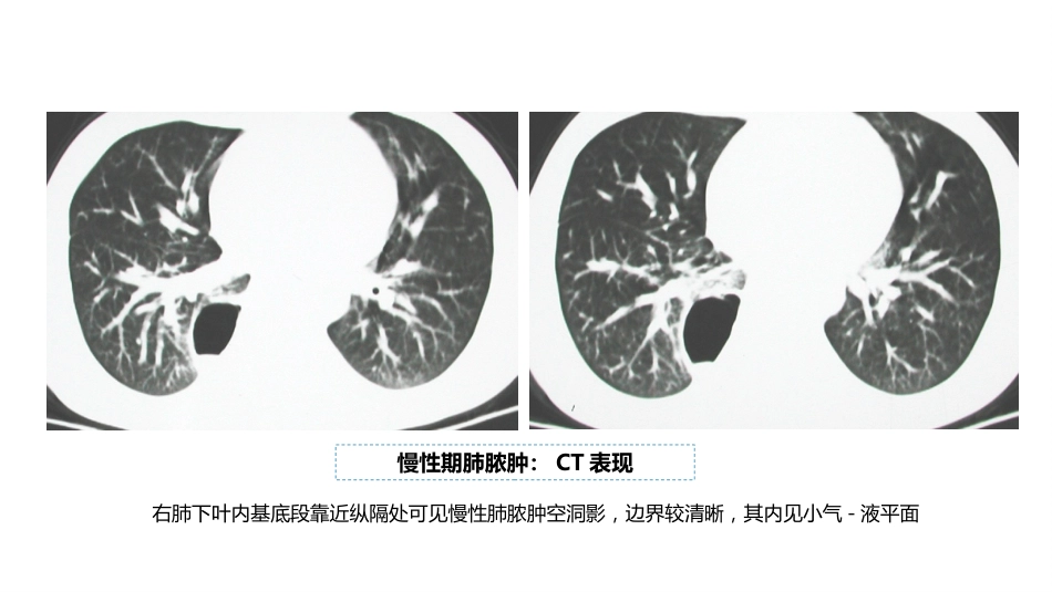 呼吸系统——肺脓肿、肺结核_第10页