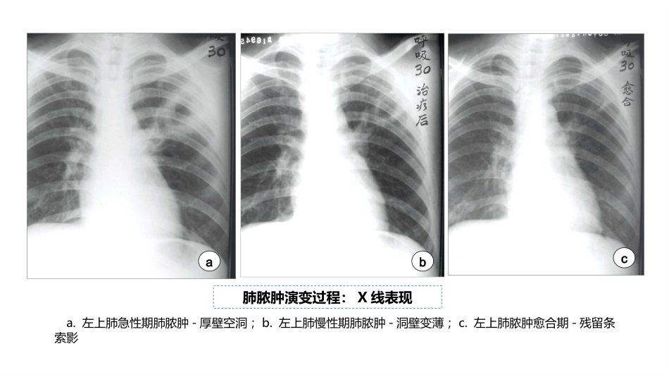 呼吸系统——肺脓肿、肺结核_第11页