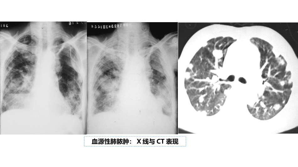 呼吸系统——肺脓肿、肺结核_第13页