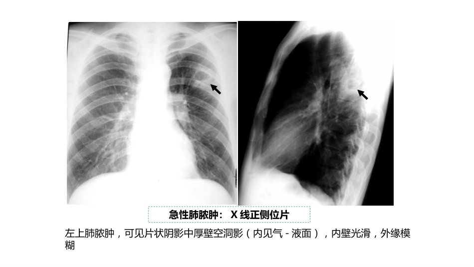 呼吸系统——肺脓肿、肺结核_第7页
