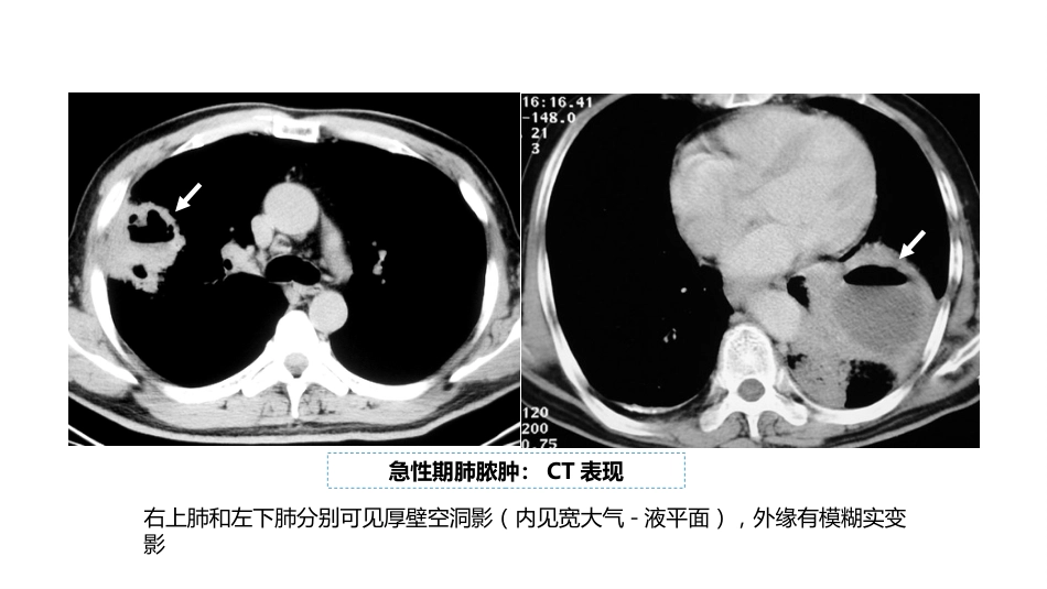 呼吸系统——肺脓肿、肺结核_第8页