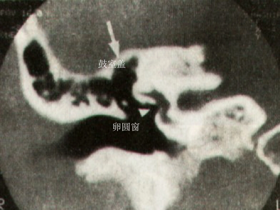 慢性中耳炎幻灯_第5页