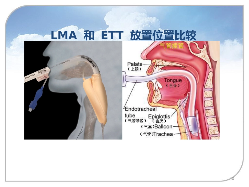 喉罩的进展及临床应用_第10页