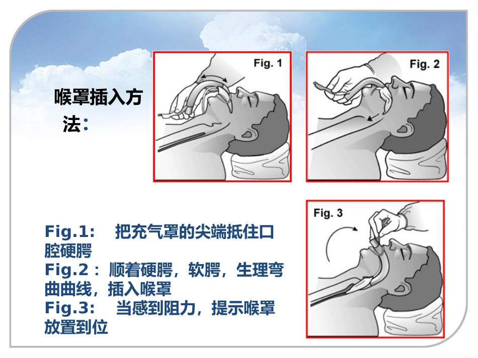 喉罩的进展及临床应用_第12页