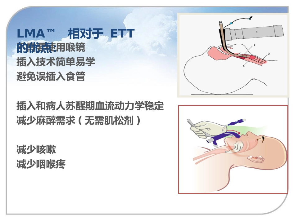喉罩的进展及临床应用_第15页
