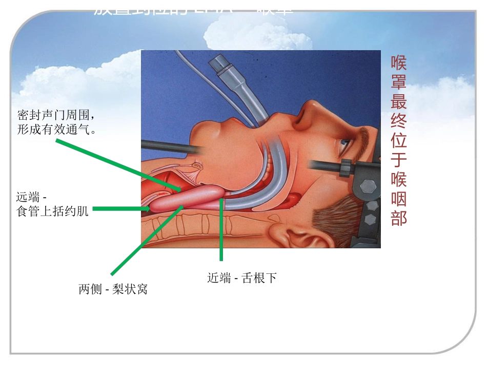 喉罩的进展及临床应用_第9页