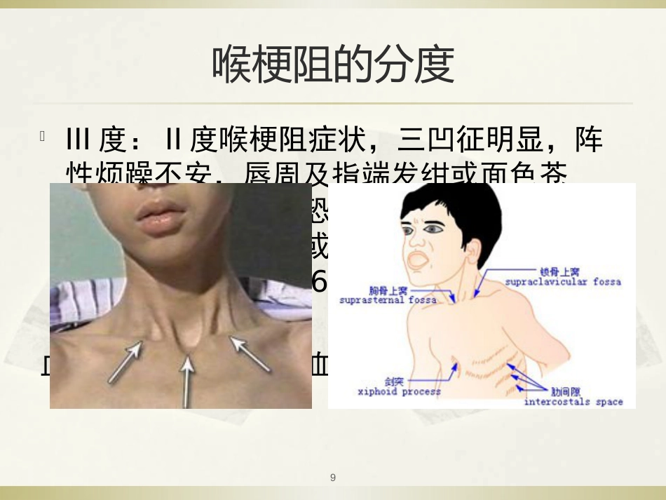 急性喉炎医学PPT_第9页