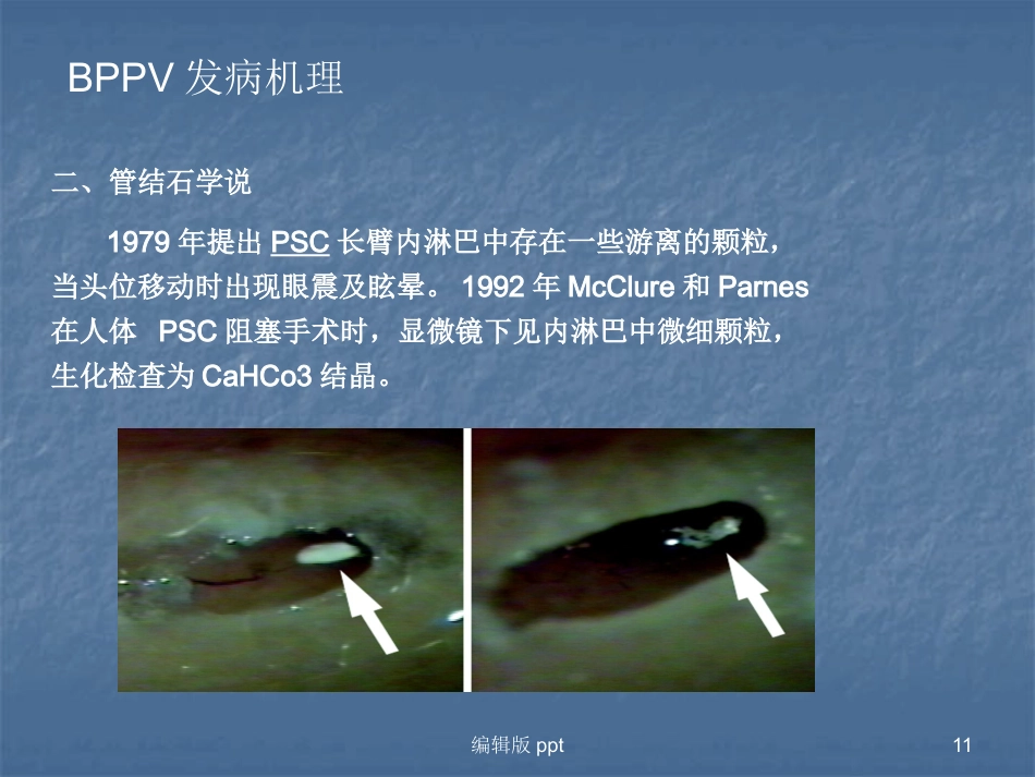 常见耳源性眩晕的诊断与治疗PPT课件_第11页