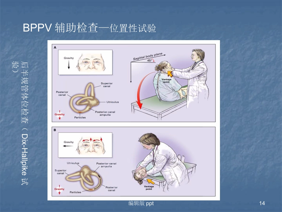 常见耳源性眩晕的诊断与治疗PPT课件_第14页