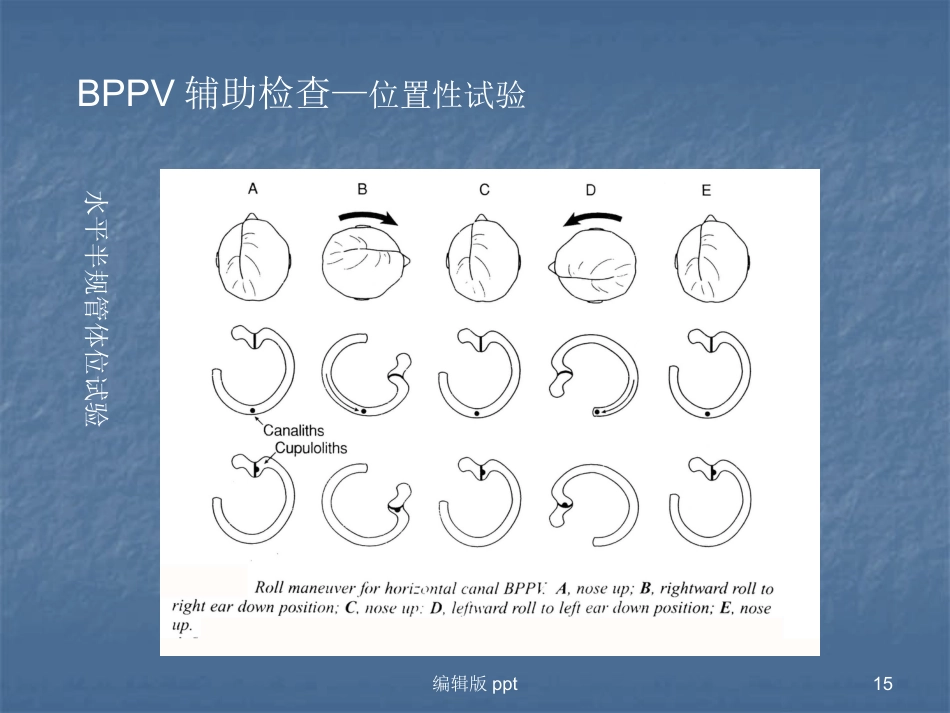 常见耳源性眩晕的诊断与治疗PPT课件_第15页