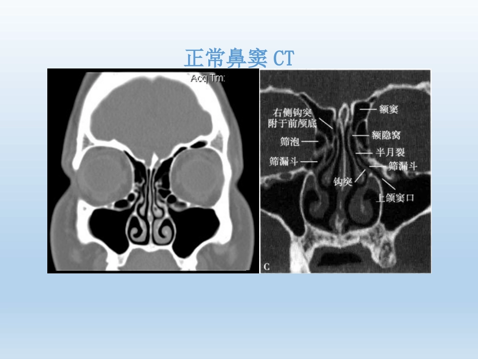 慢性鼻窦炎医疗业务学习_第7页