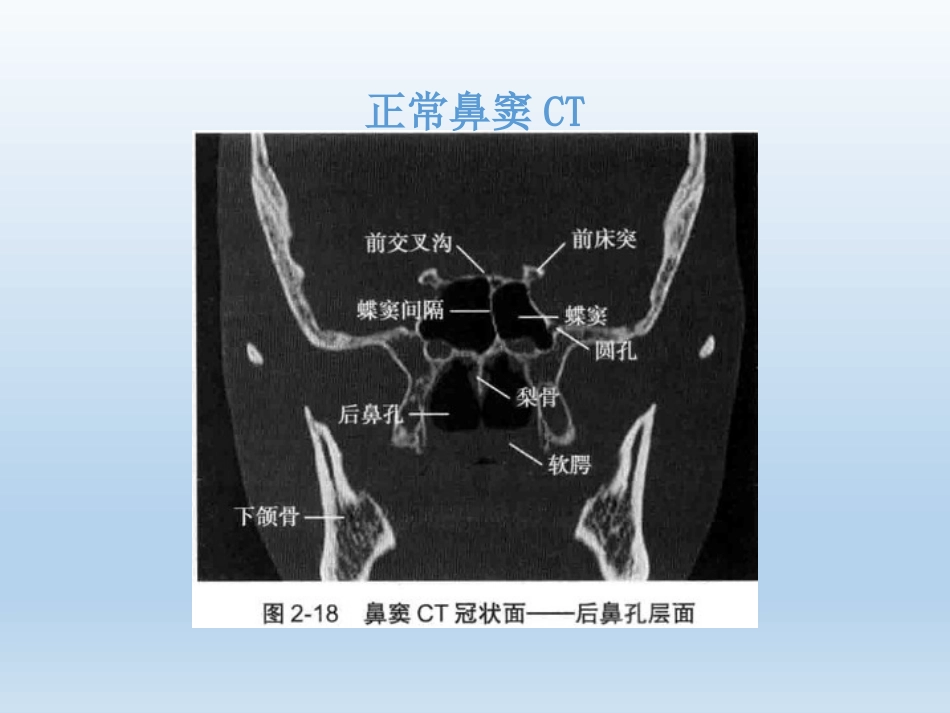 慢性鼻窦炎医疗业务学习_第8页