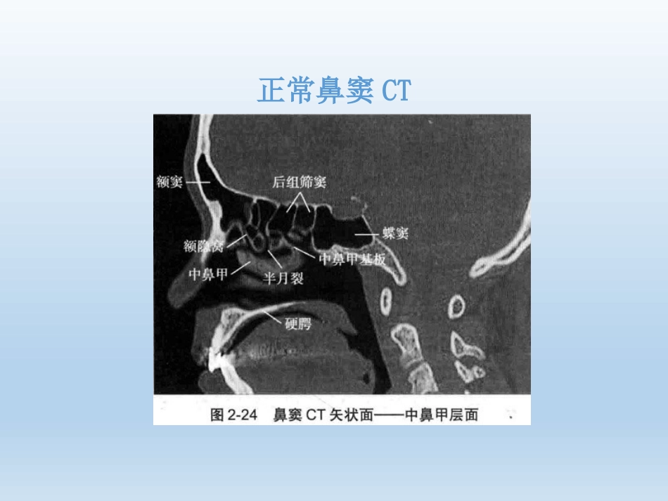 慢性鼻窦炎医疗业务学习_第9页