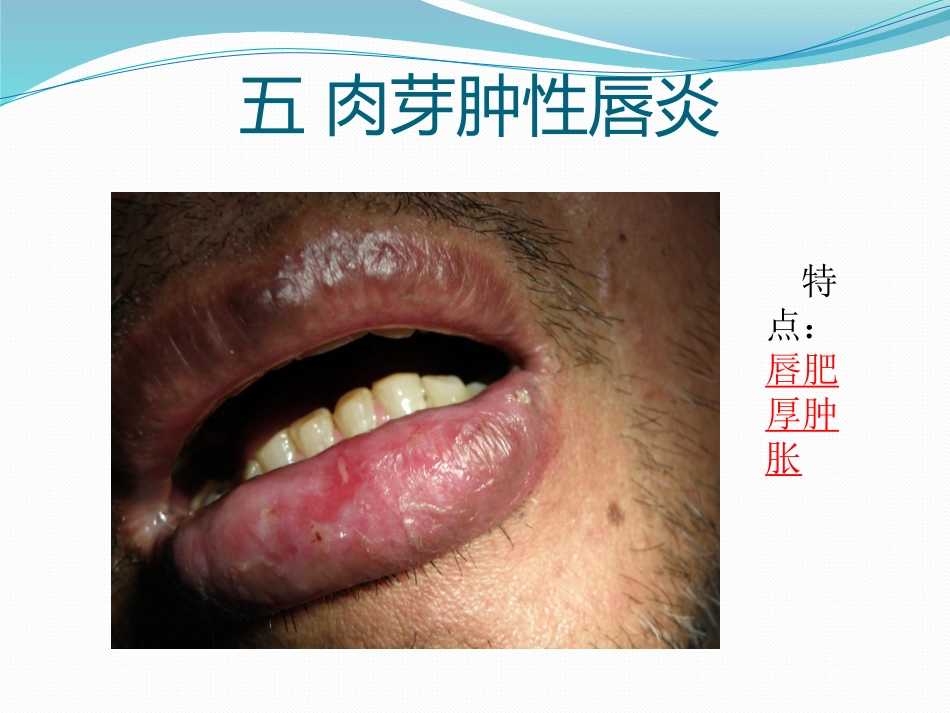 唇舌疾病 PPT_第10页