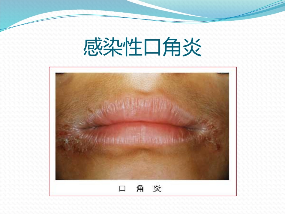 唇舌疾病 PPT_第14页