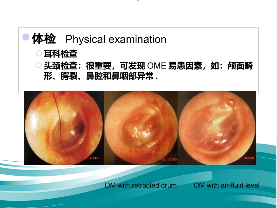 儿童分泌性中耳炎诊治 PPT_第11页