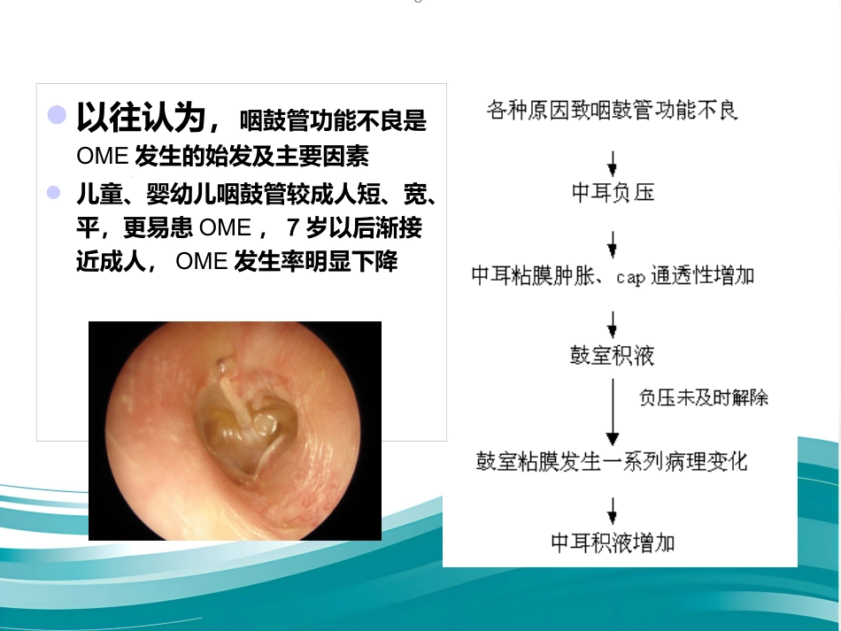 儿童分泌性中耳炎诊治 PPT_第6页
