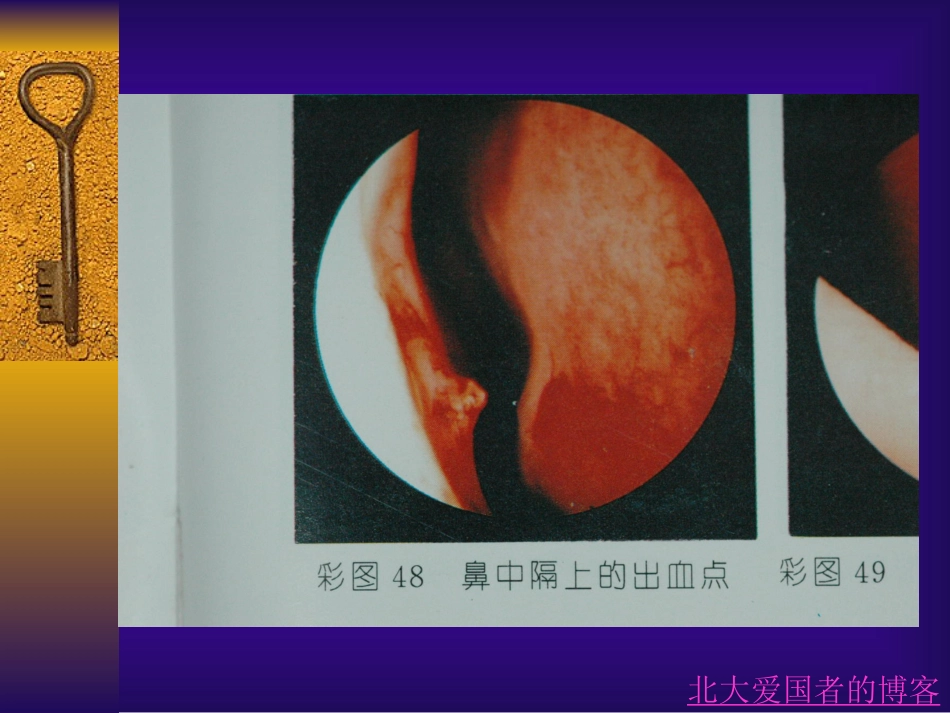 鼻部常见疾病_第13页