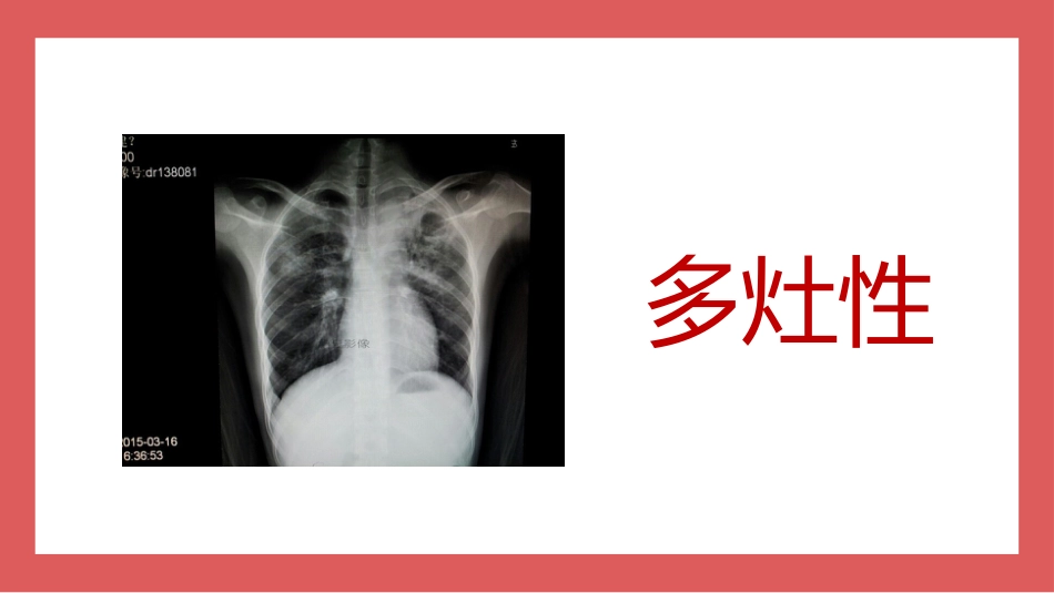 成人肺结核CT特征_第5页