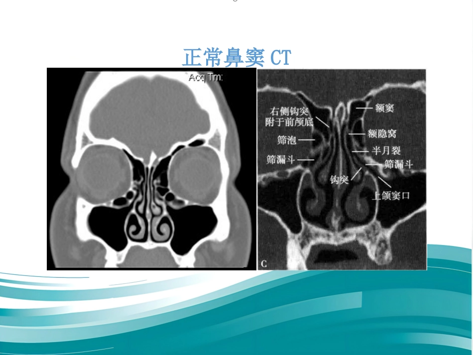 慢性鼻窦炎_第7页