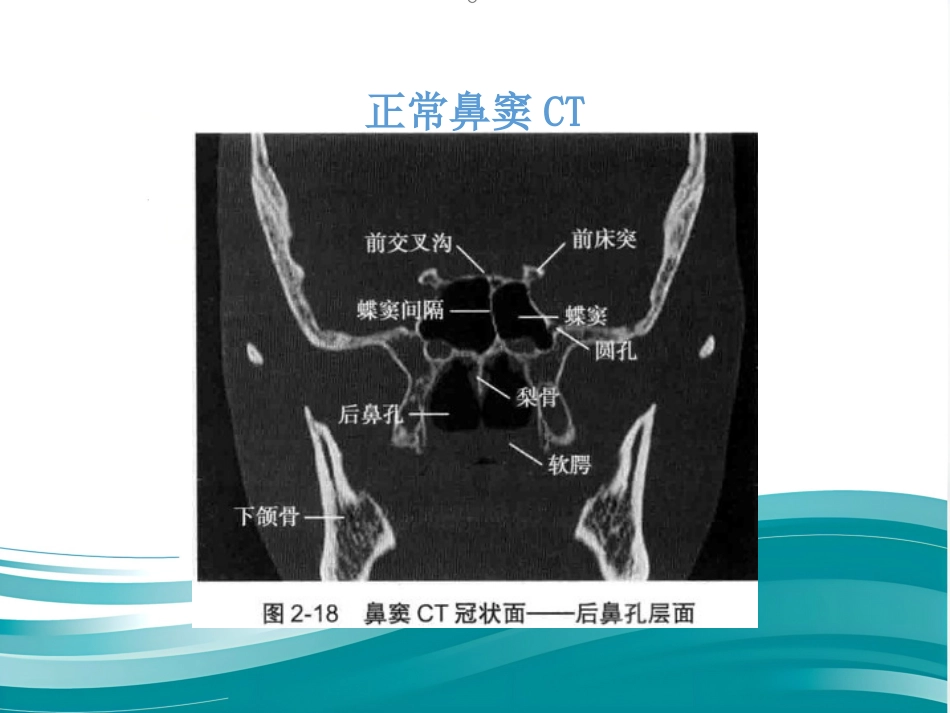慢性鼻窦炎_第8页