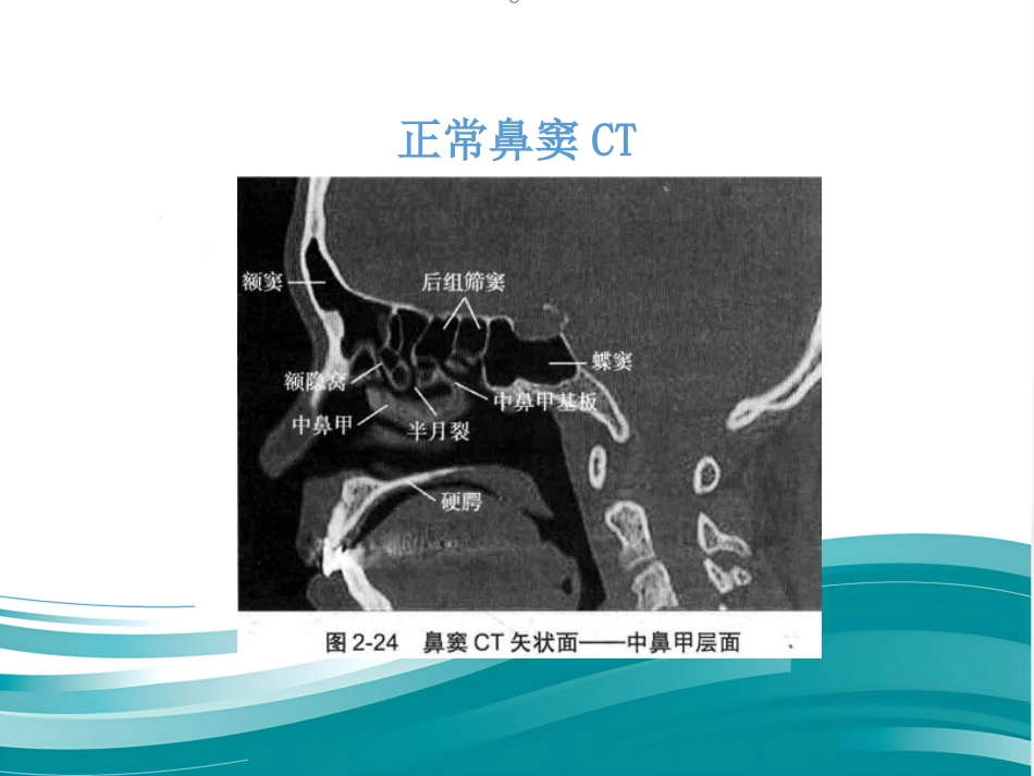 慢性鼻窦炎_第9页