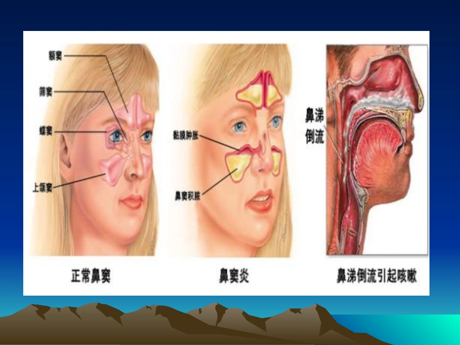 鼻窦负压置换疗法_第5页