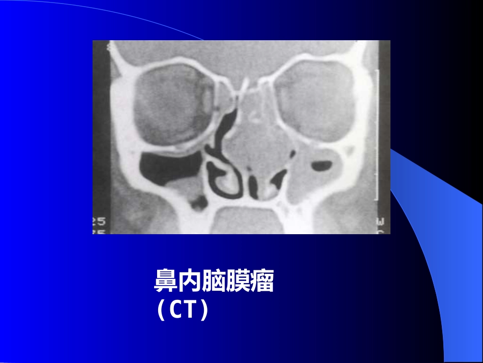 鼻窦炎医学_第10页
