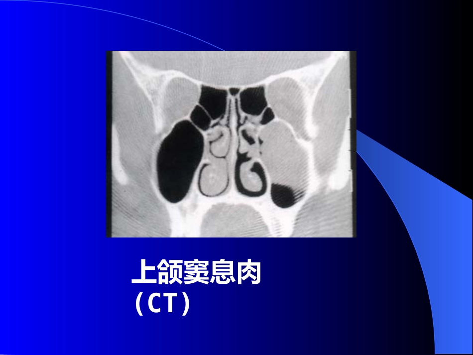 鼻窦炎医学_第13页