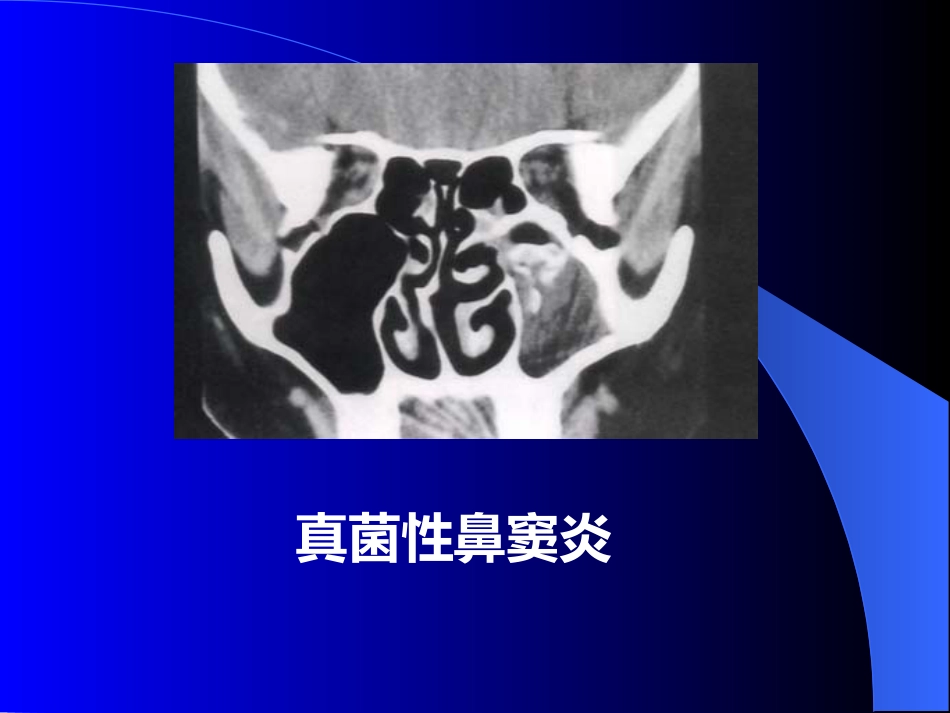 鼻窦炎医学_第14页