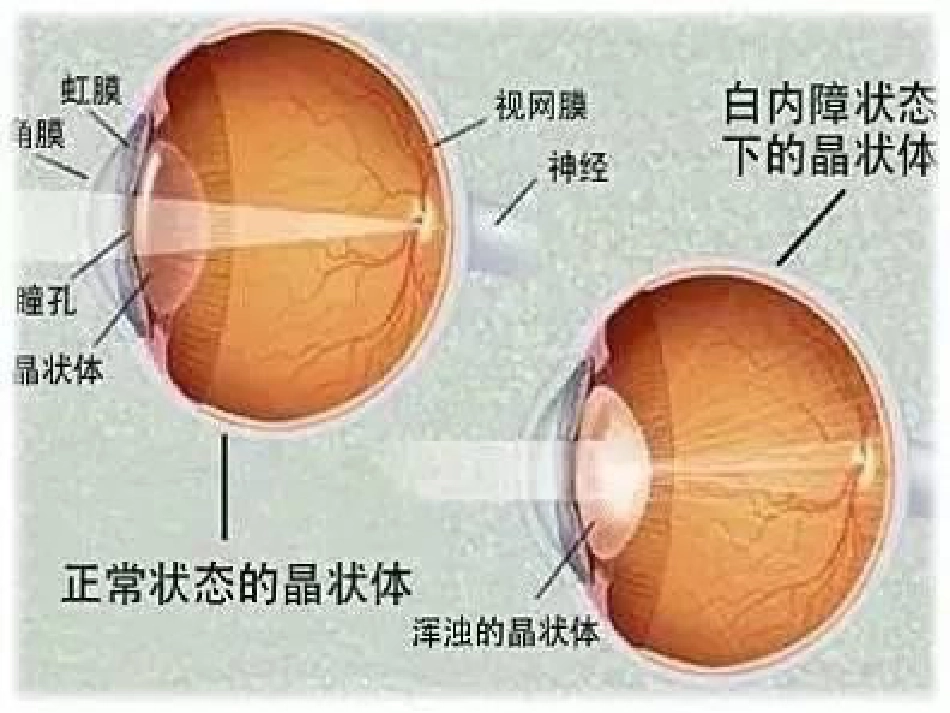 白内障护理查房_第13页