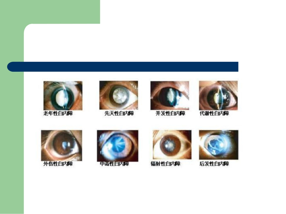白内障护理查房_第15页